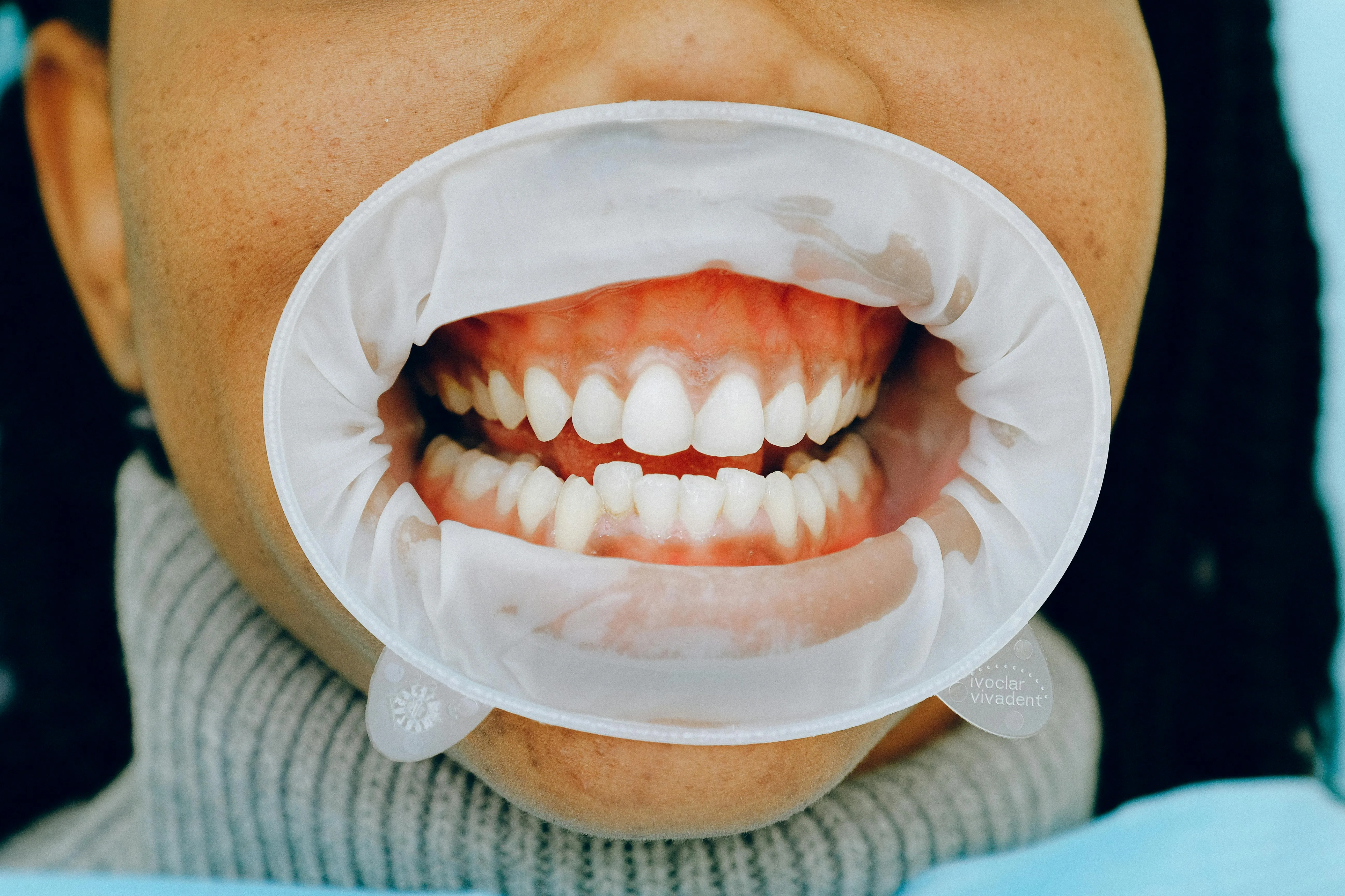 Gum Health and Bleeding Issues